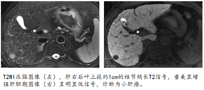 小肝癌利器2.png